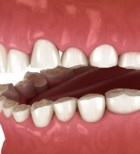 בעיות סגר בשיניים - תמונת המחשה